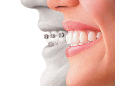 Uyesugi Dental | Dental Bridges, Inlays  amp  Onlays and Cosmetic Dentistry