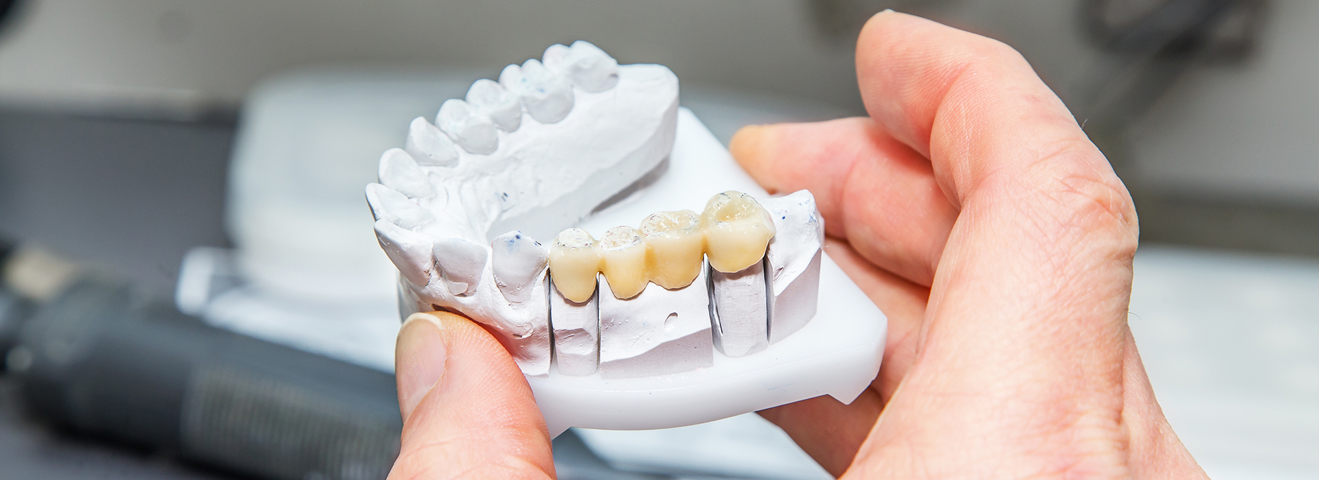 Uyesugi Dental | Veneers, Dental Bridges and Extractions