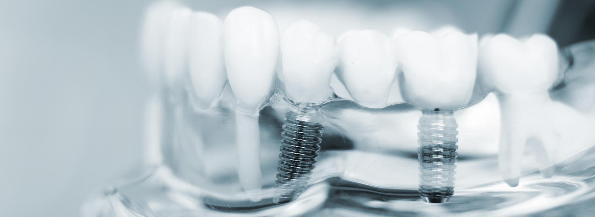 Uyesugi Dental | Dental Cleanings, ZOOM  Whitening and Veneers